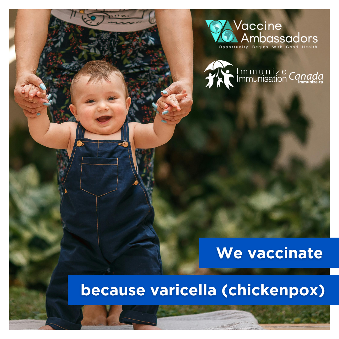We vaccinate because varicella (chickenpox)
